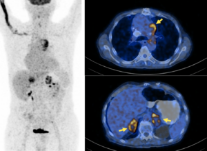 PET-CT - Vereos Digital PET-CT clinical image