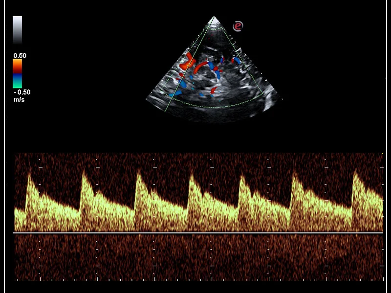 DTlMedical_MyLaOmega_esaote_ecografie_Transcranial_Doppler_img2