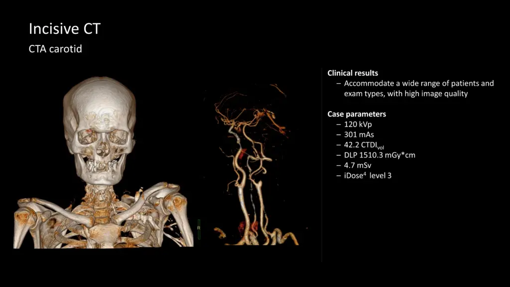 DTLMedical_philips_CT_Incisive_imagine_clinica_carotida