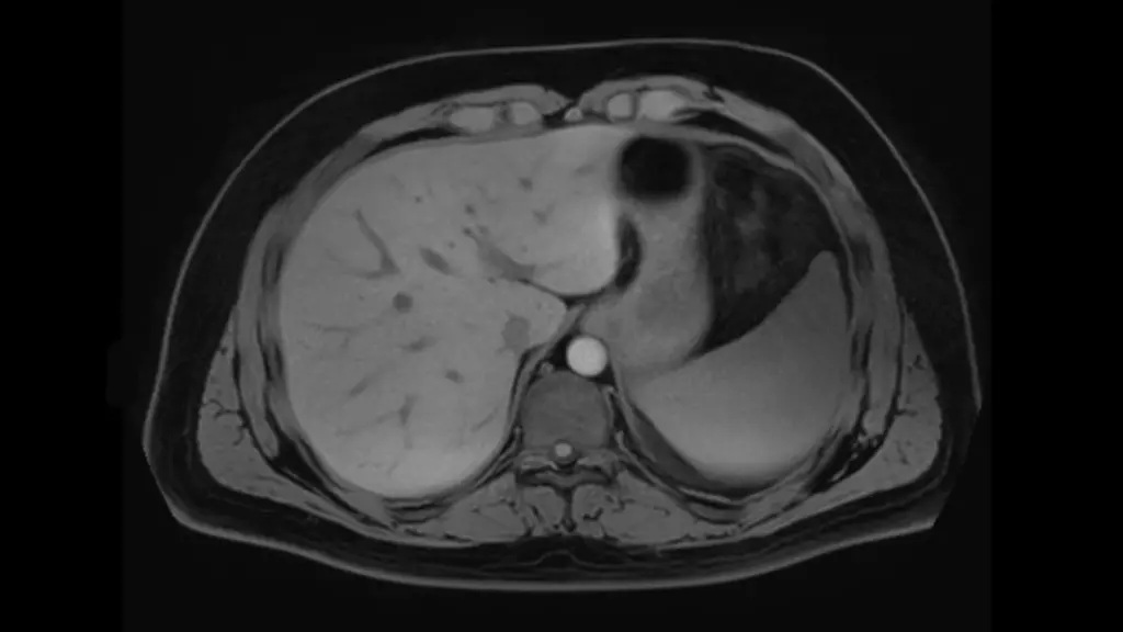 DTLMedical_philips_rmn_ingenia_ambition_S_1.5T_imagine_clinica_img5