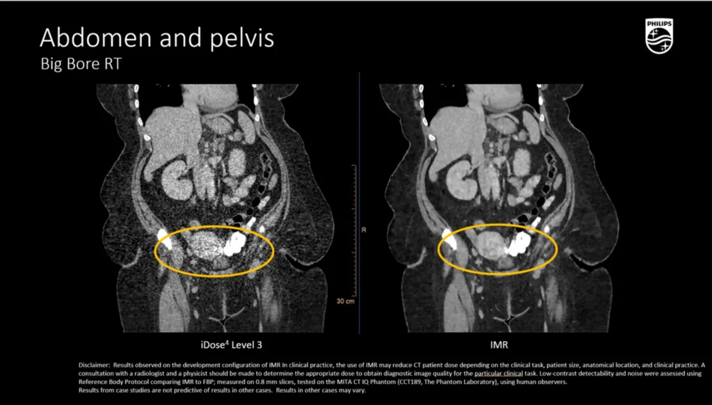 dtlmedical_philips_computer_tomograf_BIG_BORE_imagine_clinica_1