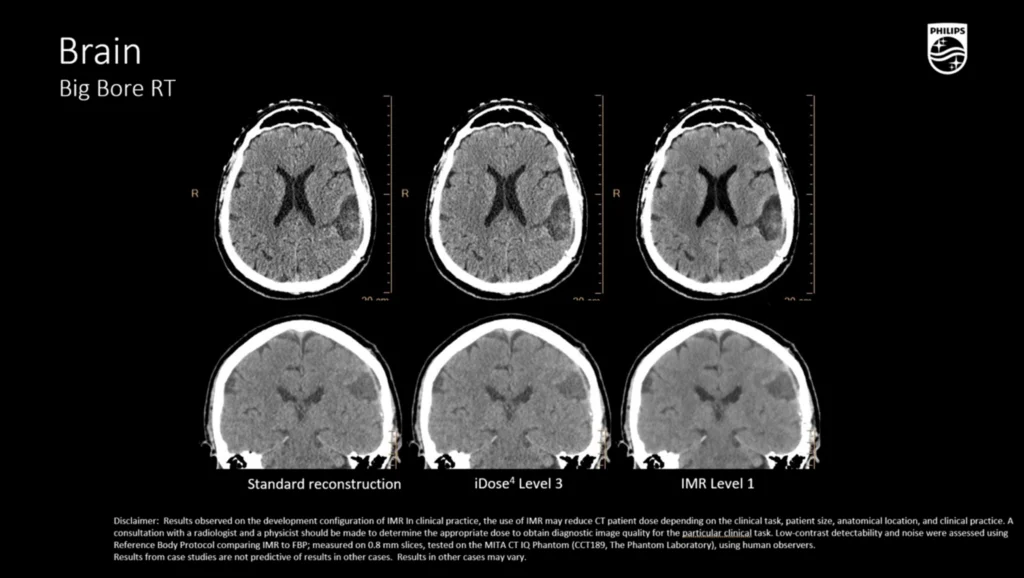 dtlmedical_philips_computer_tomograf_BIG_BORE_imagine_clinica_2