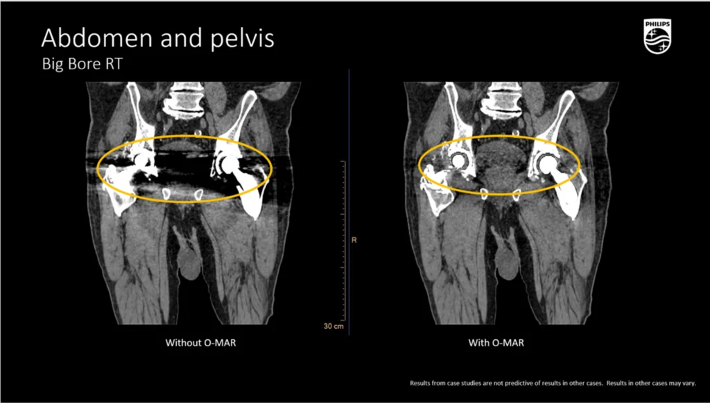 dtlmedical_philips_computer_tomograf_BIG_BORE_imagine_clinica_5