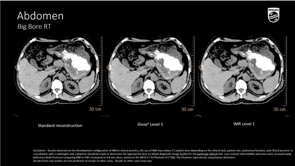 dtlmedical_philips_computer_tomograf_BIG_BORE_imagine_clinica_6