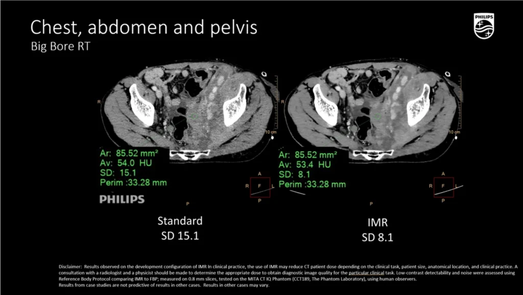 dtlmedical_philips_computer_tomograf_BIG_BORE_imagine_clinica_8