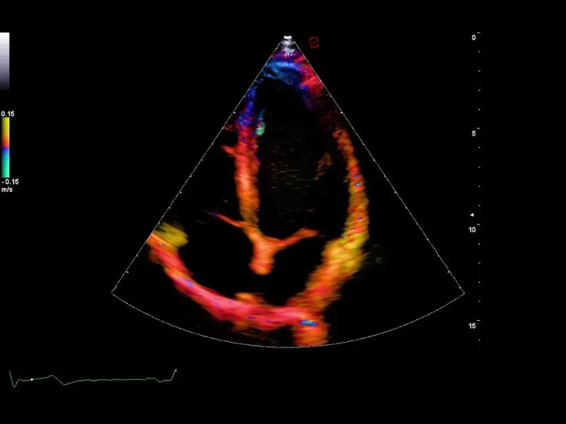csm_esaote-clinical-images-C30-TVM-4CH_b9a859c1e4
